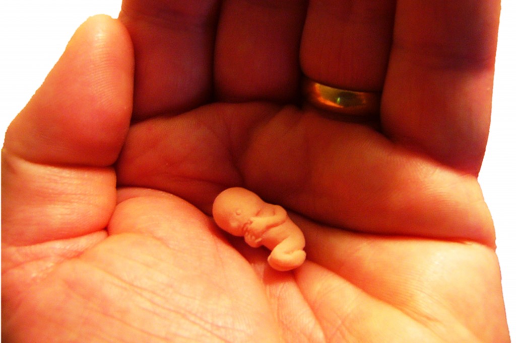 Как лечить поликистоз яичников Как вылечить поликистоз яичников видео